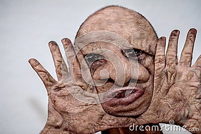 Portrait of ugly, repugnant, hideous and disfigured man with burned skin, repulsive monster, freak of nature Stock Photo