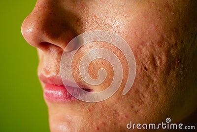 Post-acne, scars and red festering pimples on the face of a young woman. concept of skin problems and harmonic failure Stock Photo