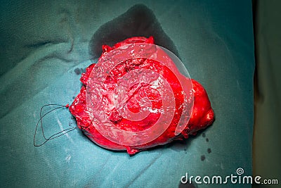 Posterior mediastinal mass specimen Stock Photo