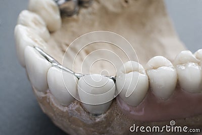 Practical sample of dental implantation close-up Stock Photo