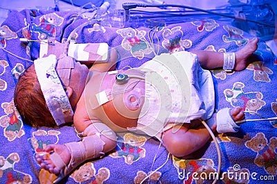 Premature Baby Stock Photo