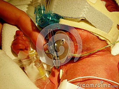 Premature Baby in NICU with CPAP Stock Photo