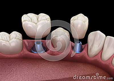 Premolar and Molar tooth crown installation over implant - concept. 3D illustration of human teeth Cartoon Illustration