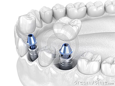 Premolar and Molar tooth crown installation over implant - white concept. 3D illustration of human teeth and dentures Cartoon Illustration