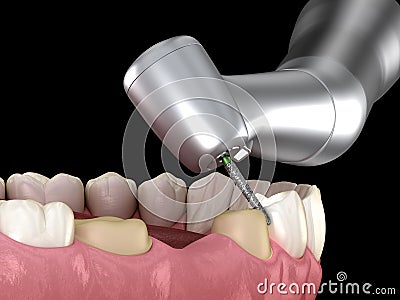 Premolar preparation process for dental crown placement. Medically accurate illustration Cartoon Illustration