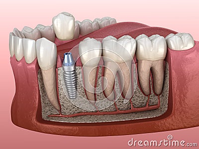 Premolar tooth crown installation over implant abutment. Medically accurate 3D illustration of human teeth and dentures Cartoon Illustration