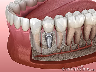 Premolar tooth recovery with implant. Medically accurate 3D illustration of human teeth and dentures Cartoon Illustration
