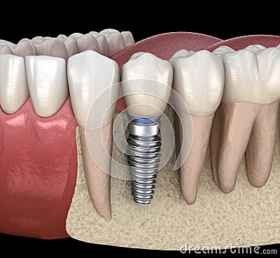 Premolar tooth recovery with implant. Medically accurate 3D illustration of human teeth and dentures Cartoon Illustration