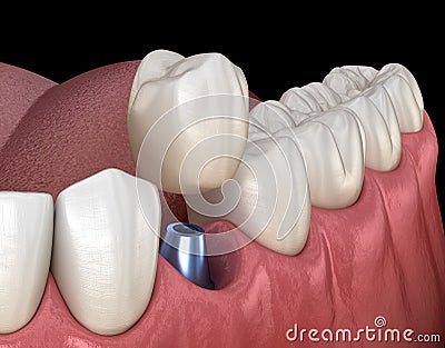 Premolar tooth recovery with implant. Medically accurate 3D illustration of human teeth and dentures Cartoon Illustration