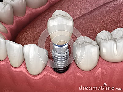 Premolar tooth recovery with implant. Medically accurate 3D illustration of human teeth and dentures Cartoon Illustration