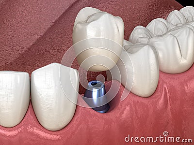 Premolar tooth recovery with implant. Medically accurate 3D illustration of human teeth and dentures Cartoon Illustration