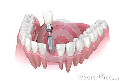 Premolar tooth recovery with implant. Medically accurate 3D illustration of human teeth and dentures concept Cartoon Illustration