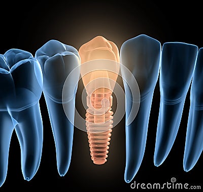 Premolar tooth recovery with implant, x-ray view. Medically accurate 3D illustration of human teeth and dentures Cartoon Illustration