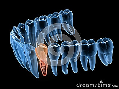 Premolar tooth recovery with implant, x-ray view. Medically accurate 3D illustration of human teeth and dentures Cartoon Illustration