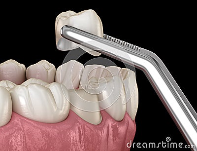 Preparated premolar tooth and ceramic crown placement. Medically accurate 3D illustration Cartoon Illustration