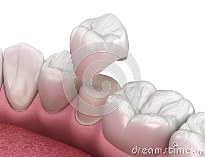 Preparated premolar tooth and dental crown placement. Medically accurate 3D illustration Cartoon Illustration