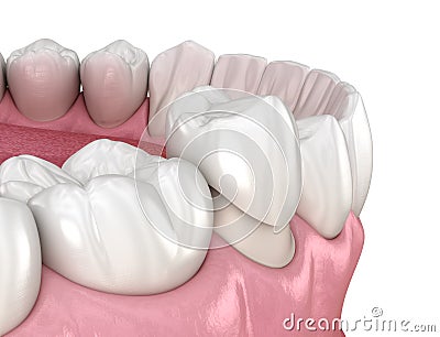 Preparated premolar tooth and dental crown placement. Medically accurate 3D illustration Cartoon Illustration