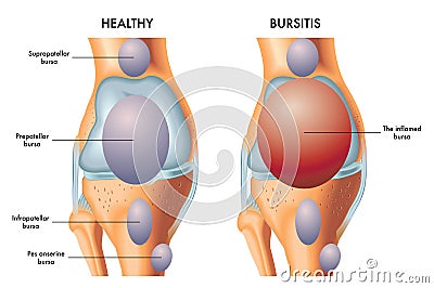 Prepatellar bursitis Vector Illustration