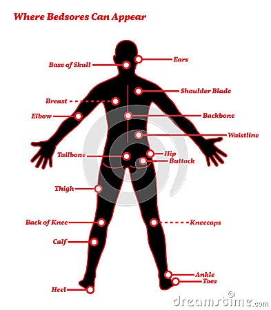 Pressure Sores Bedsores Ulcers Human Anatomy Illustration Vector Illustration