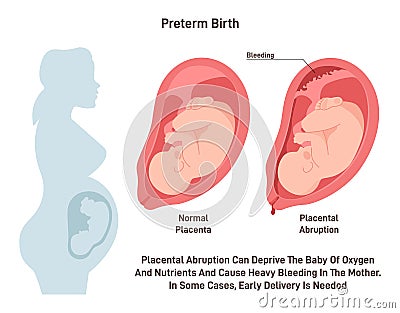 Preterm birth. Placental abrupted and early baby delivery. Pregnancy Vector Illustration