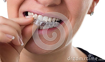 Preventive teeth braces Stock Photo