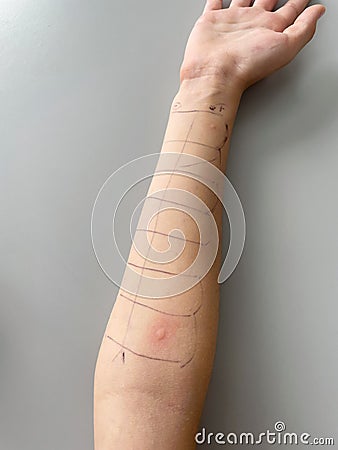 Prick test for inhalant allergies with positive reaction to histamine and mites Stock Photo