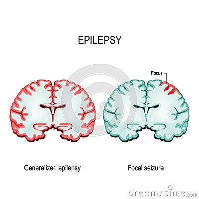 Primary generalized epilepsy and focal seizures Vector Illustration