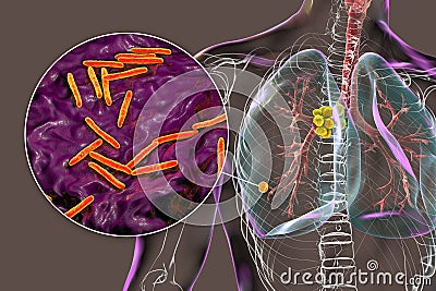 Primary lung tuberculosis, 3D illustration Cartoon Illustration