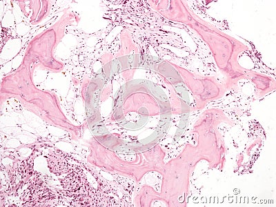 Primary myelofibrosis in bone marrow. Stock Photo