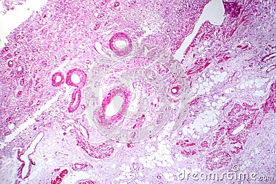 Primary particulate contracted kidney, light micrograph Stock Photo