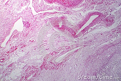 Primary particulate contracted kidney, light micrograph Stock Photo