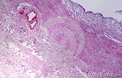Primary particulate contracted kidney, light micrograph Stock Photo