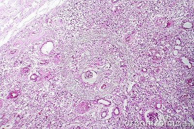 Primary particulate contracted kidney, light micrograph Stock Photo