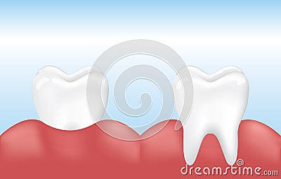 Vector Image Clean Healthy Tooth with Inflamed Gum. Medical Dental Oral Problem. Enamel Cleanliness. Isolated on White Background. Stock Photo