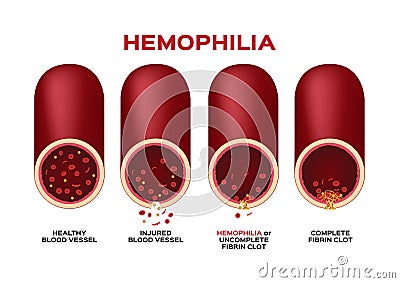 Hemophilia or haemophilia and blood vessel vector / bleeding / wound Vector Illustration