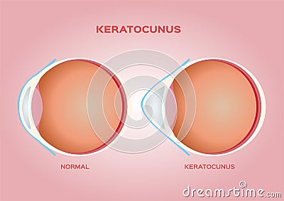 Eye cornea and keratoconus vector / anatomy Vector Illustration