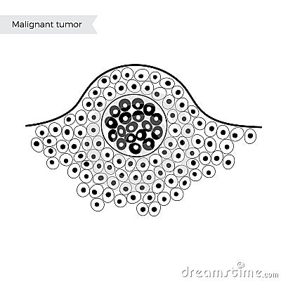 Vector isolated illustration of benign tumor Vector Illustration