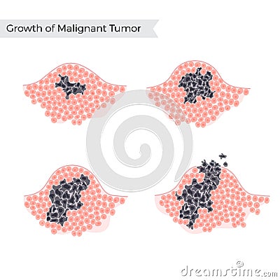 Vector isolated illustration of malignant tumor Vector Illustration