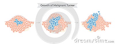Vector isolated illustration of malignant tumor Vector Illustration