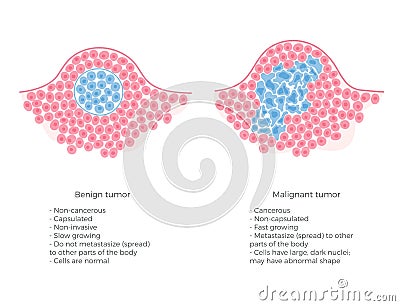 Vector illustration of malignant and benign tumor Vector Illustration