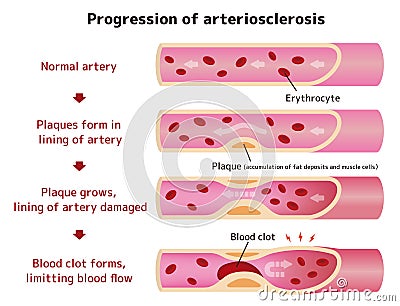 Progression of arteriosclerosis illustration Vector Illustration