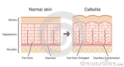 Comparative illustration of normal skin and cellulite`s skin Vector Illustration