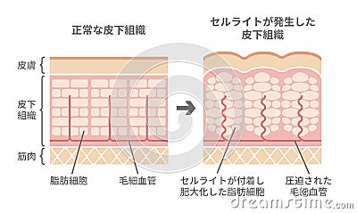 Comparative illustration of normal skin and cellulite`s skin Vector Illustration