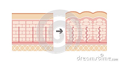 Comparative illustration of normal skin and cellulite`s skin Vector Illustration