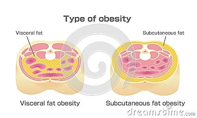 Type of obesity illustration / English Vector Illustration