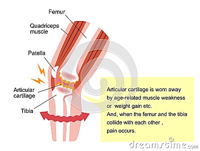 Mechanism and causes of knee joint pain / English Vector Illustration