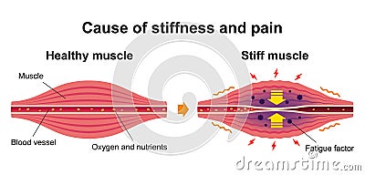 Process of muscle`s stiffness and pain / English Vector Illustration