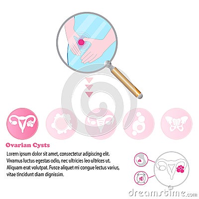 Medical infographic Ovarian cysts that could be causing women period pain. Vector Illustration