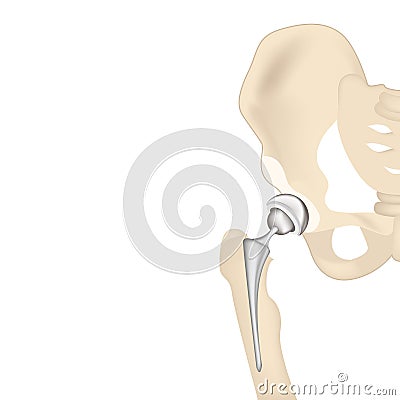 Endoprosthetics, hip joint prosthesis. Vector Illustration