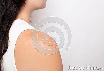 Problem skin with pigmented spots on the girl s shoulder on a white background, medical, copy space, hormonal disorders Stock Photo